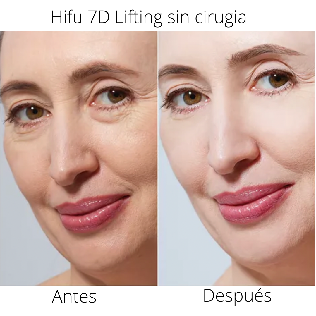 HIFU ROSTRO COMPLETO Y CUELLO