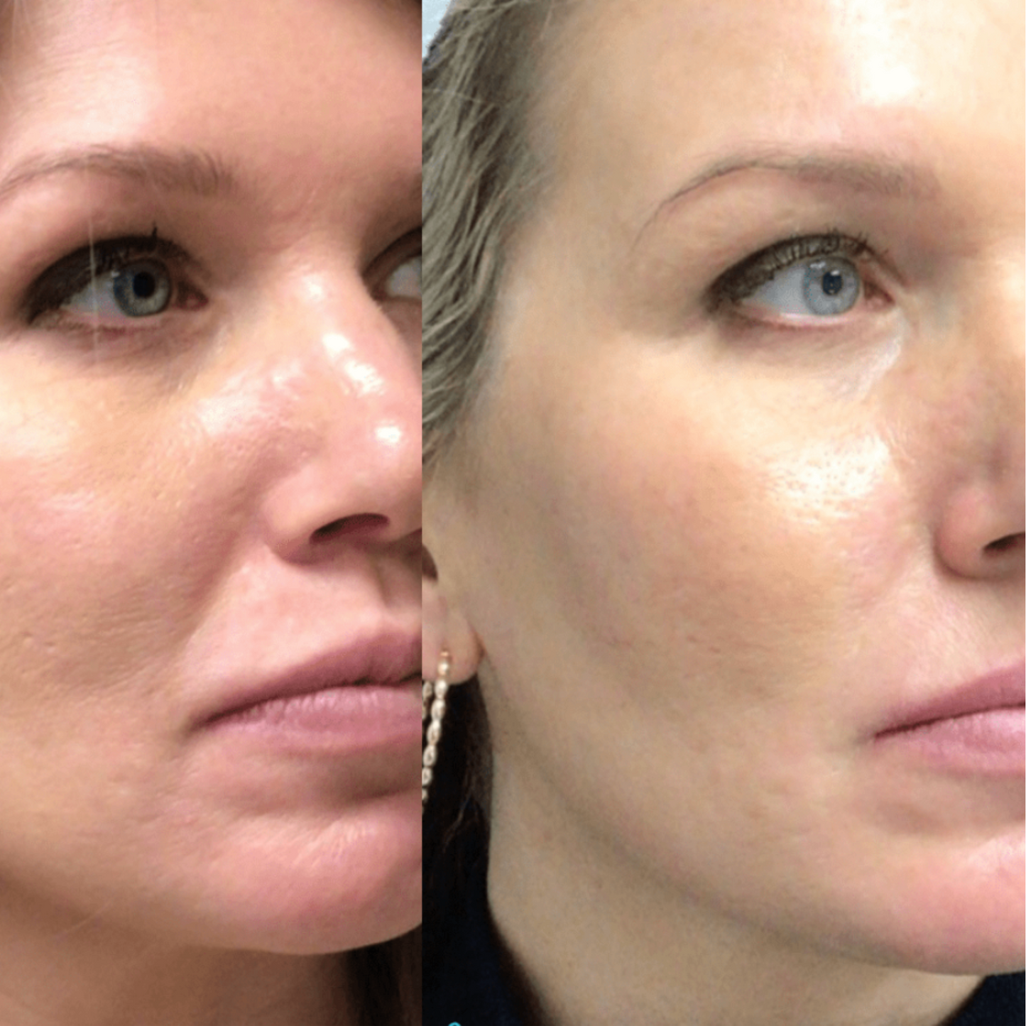 MESOTERAPIA CON VITAMINAS
