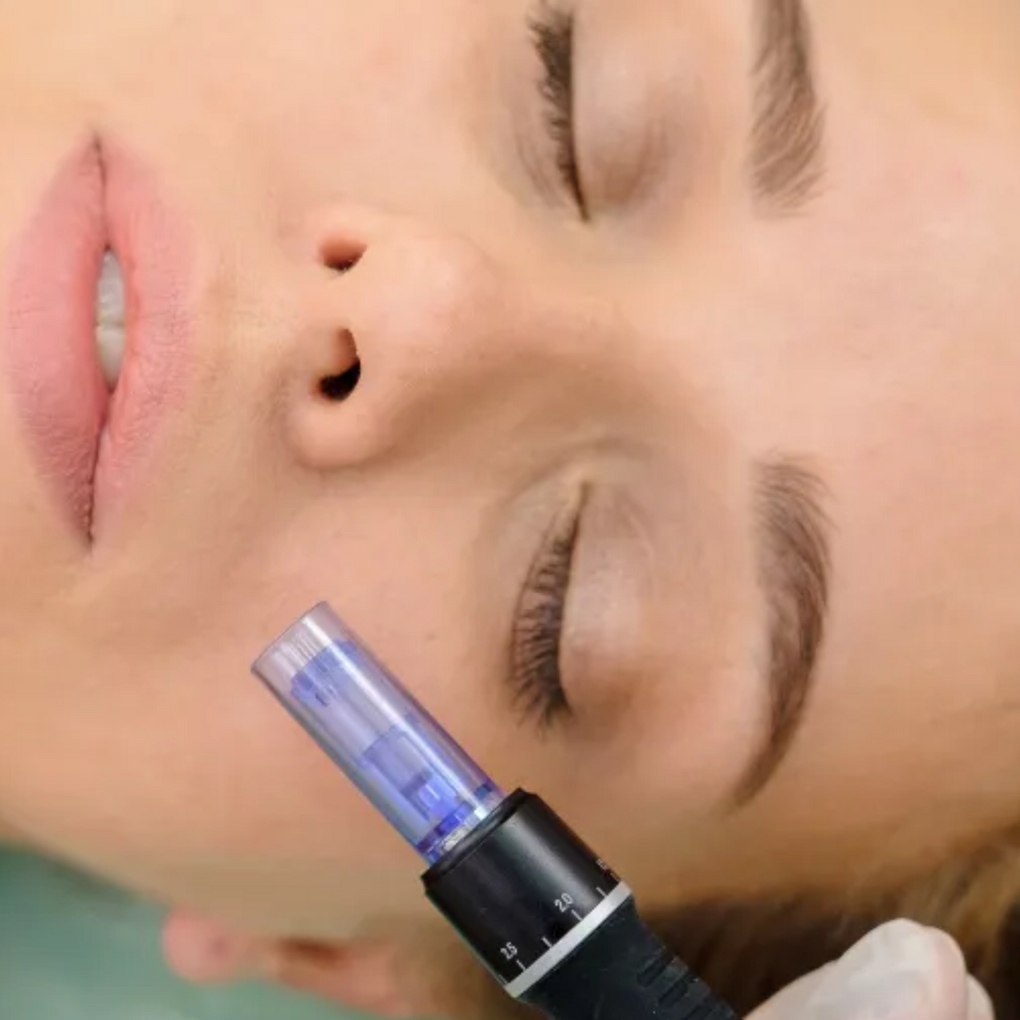 MESOTERAPIA CON VITAMINAS