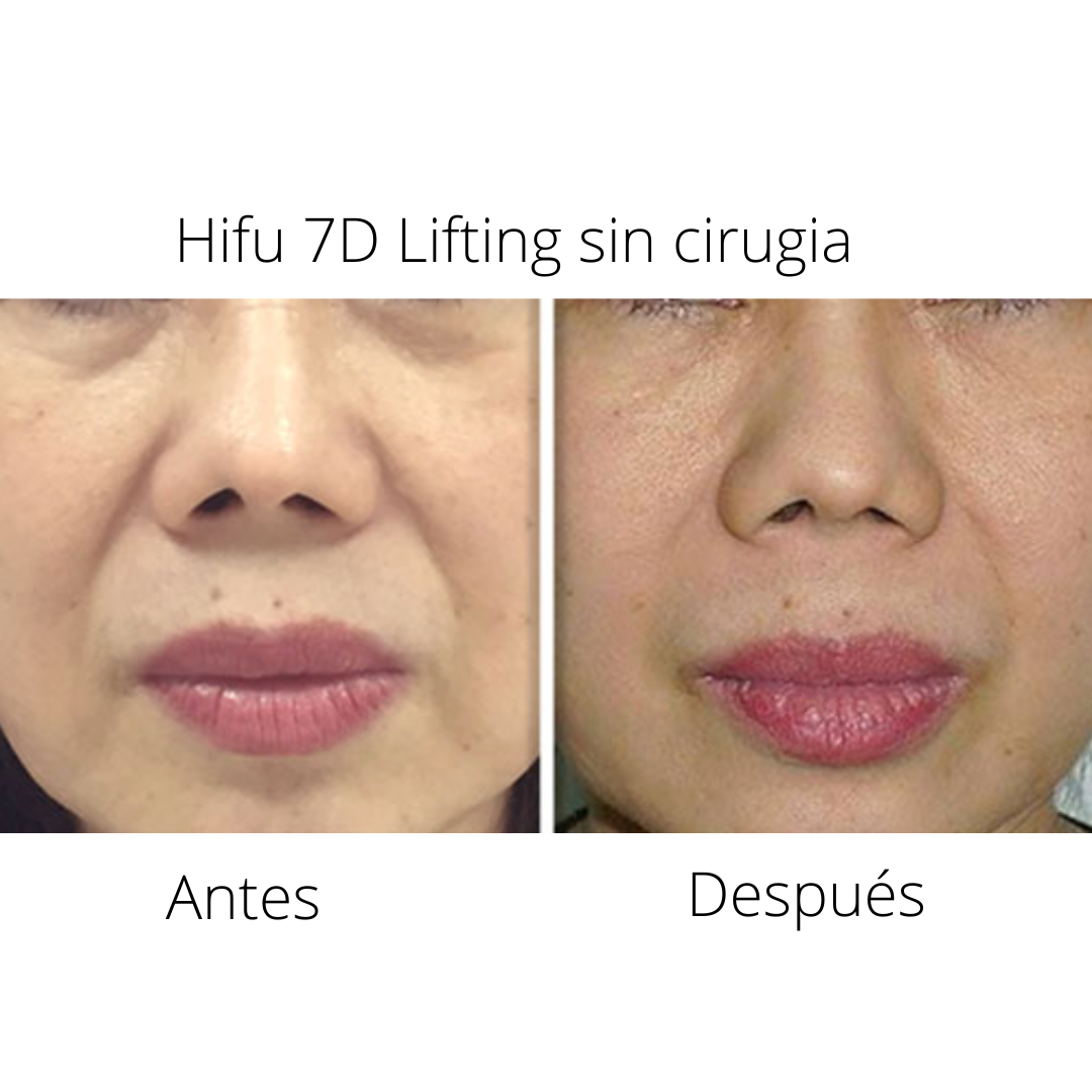 HIFU ROSTRO COMPLETO Y CUELLO