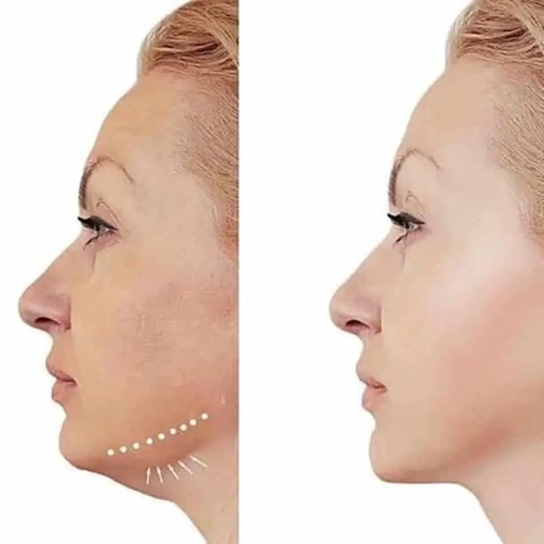 HIFU 25D ROSTRO COMPLETO Y PAPADA ¡OFERTA PREVENTA!