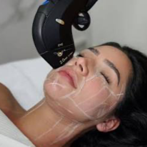 HIFU 25D ROSTRO COMPLETO, PAPADA Y CUELLO ¡OFERTA PREVENTA!